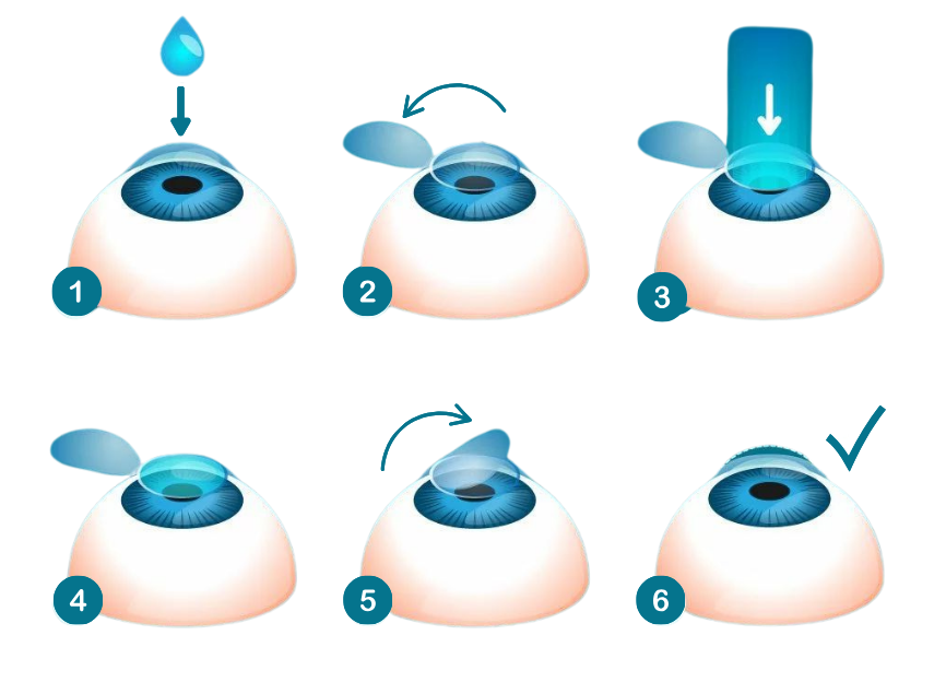 Ilustraciones que muestran los 6 pasos de la técnica LASIK para operarse los ojos con laser